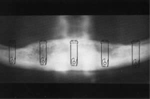 Bone measurement x-ray