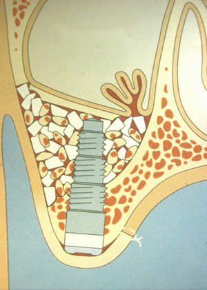 Sinus Lift