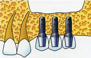 Sinus Lift